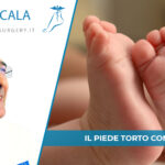 piede torto congenito