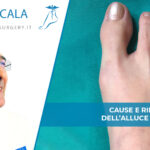 Alluce Valgo: cause e rimedi