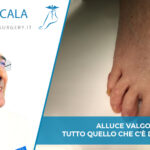 alluce valgo