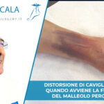 frattura malleolo