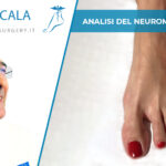 Neuroma di Morton