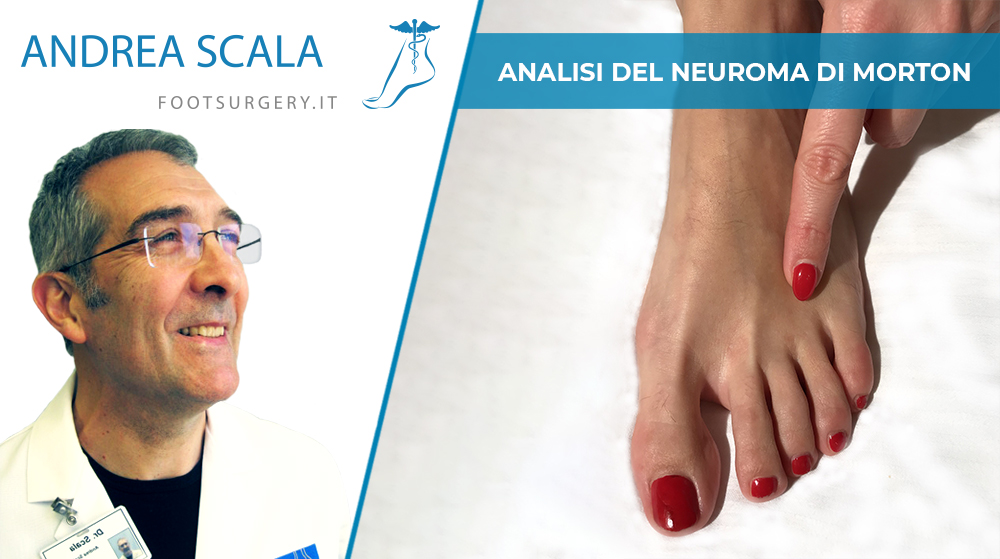 Neuroma di Morton