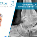 artrosi della caviglia