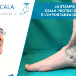 STAMPA IN 3D DELLA PROTESI DI CAVIGLIA