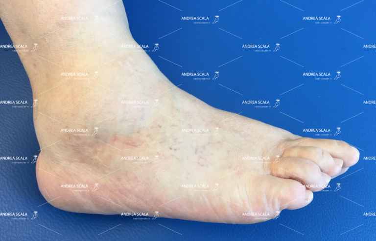 Artrosi alla caviglia