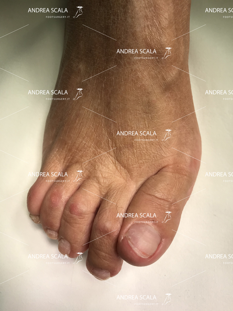 L'alluce valgo non è solo un inestetismo