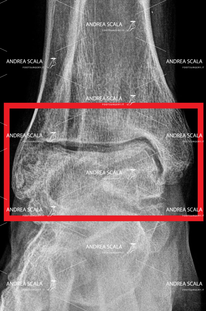 Rxgrafia frontale artosi alla caviglia