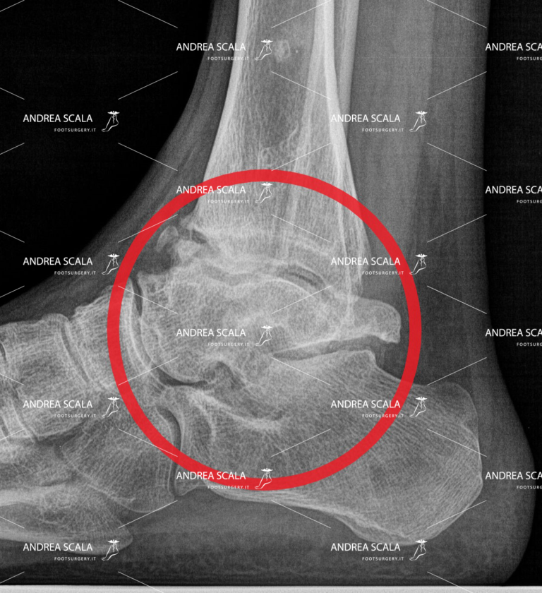 Rxgrafia laterale artosi alla caviglia