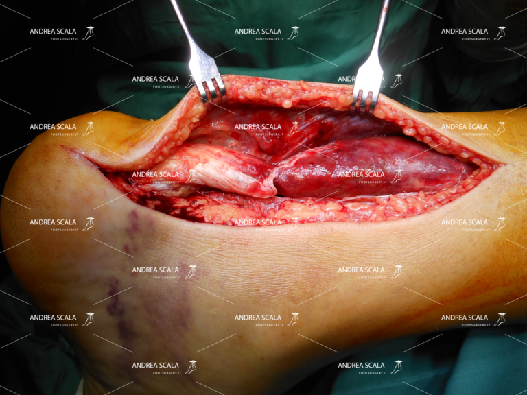 Un caso di rottura sottocutanea del tendine d’Achille