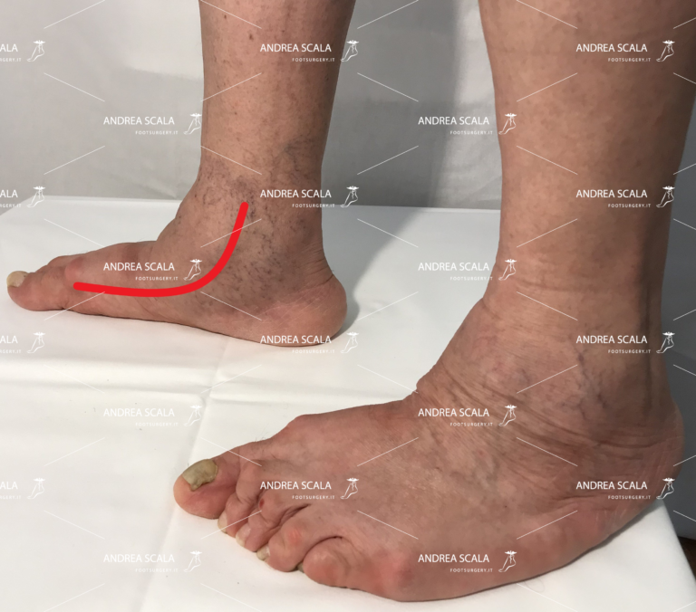 assenza dell’arco del piede