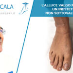 L'alluce valgo non è solo un inestetismo, non sottovalutarlo. 