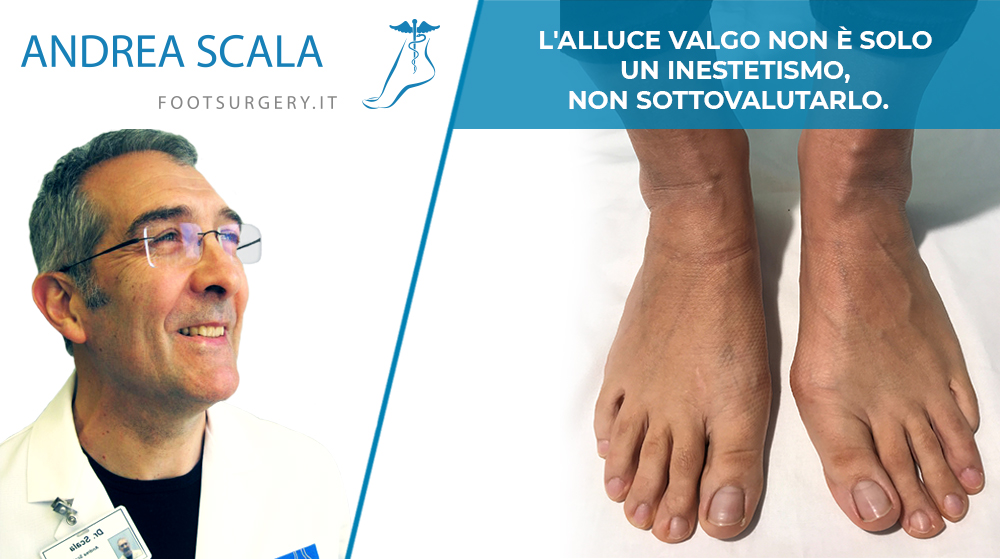 L'alluce valgo non è solo un inestetismo, non sottovalutarlo. 