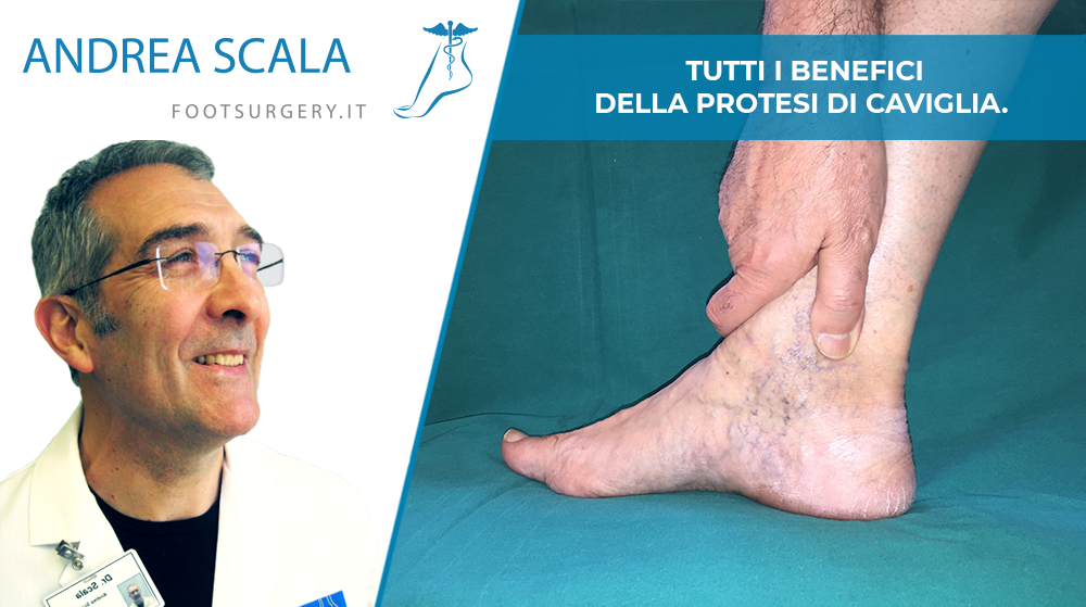 benefici della protesi di caviglia