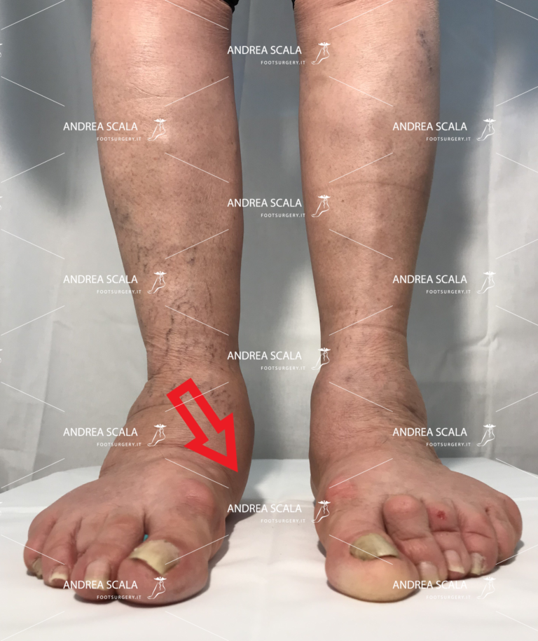 pronazione del piede verso l’interno