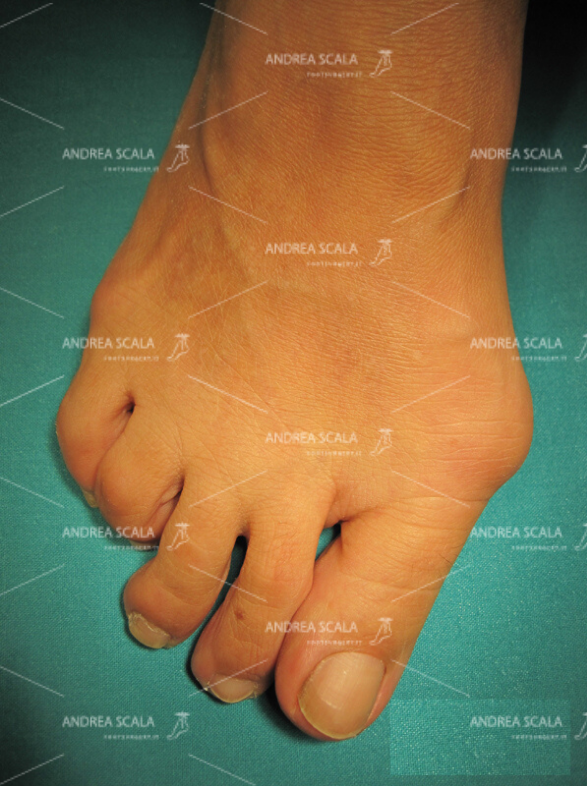 Alluce valgo Prima dell'operazione