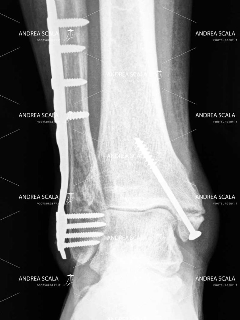 Frattura della caviglia evoluta in artrosi