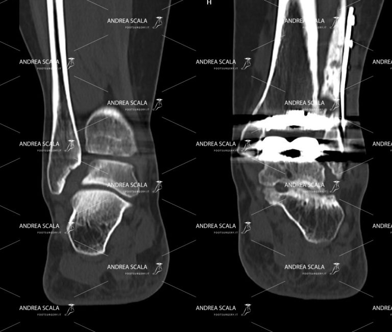 TAC caviglia con il perone tagliato