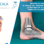 Protesi di caviglia. Il Taglio del Perone può causare la instabilità a causa del mancato allineamento