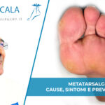 Metatarsalgia: cause, sintomi e prevenzione