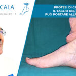 Protesi di Caviglia. Il Taglio del Perone può portare alla instabilità