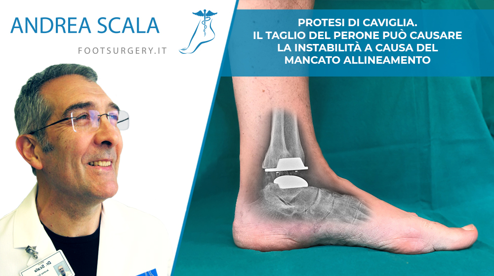 Protesi di caviglia. Il Taglio del Perone può causare la instabilità a causa del mancato allineamento