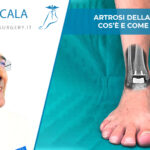 Artrosi della caviglia: cos’è e come si cura