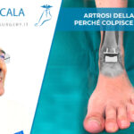 Artrosi della caviglia: perché colpisce i più giovani