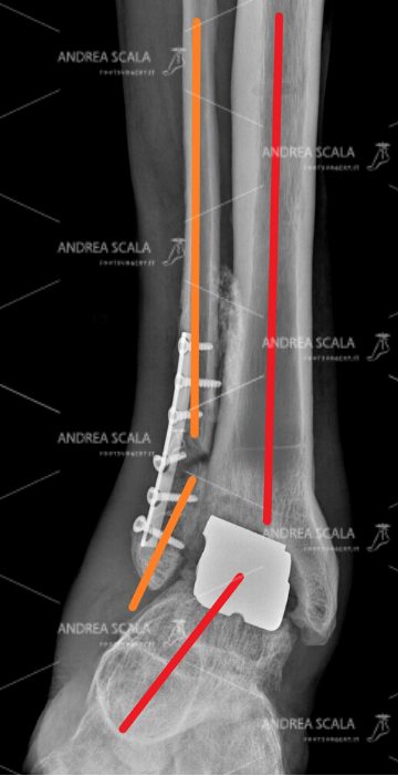 mancata guarigione del taglio del perone