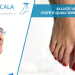 Alluce valgo: cos’è e quali sono le cause