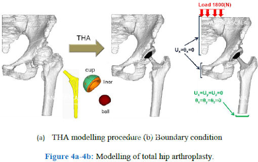 schema biomeccanica della protesi d’anca