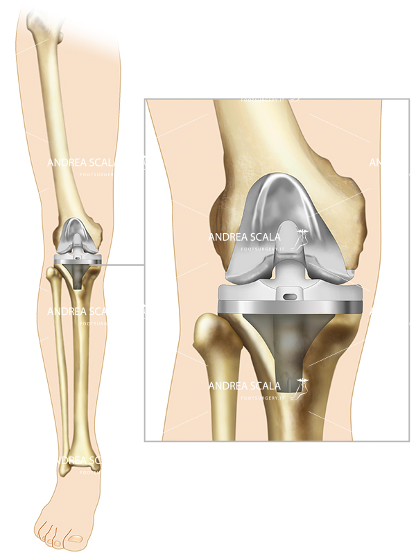 schema biomeccanica della protesi di ginocchio