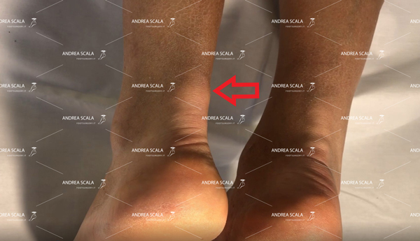 Caviglia-bloccata-e-tendinite-d’Achille