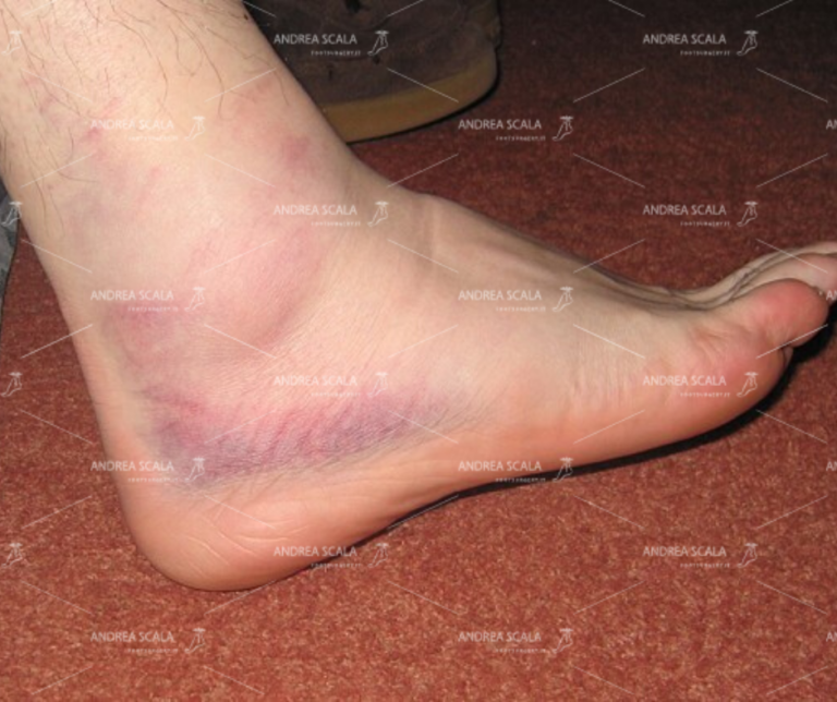 Distorsione della caviglia - Il LEGAMENTO PERONEO ASTRAGALICO ANTERIORE 