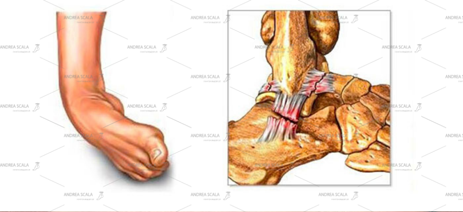 Distorsione della Caviglia