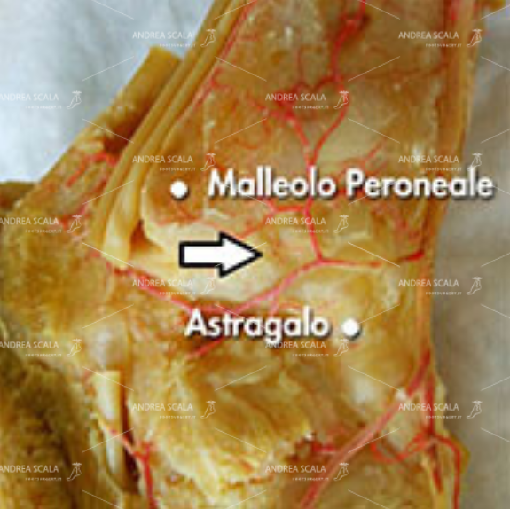 Distorsione della caviglia - i LEGAMENTI LATERALI DELLA CAVIGLIA