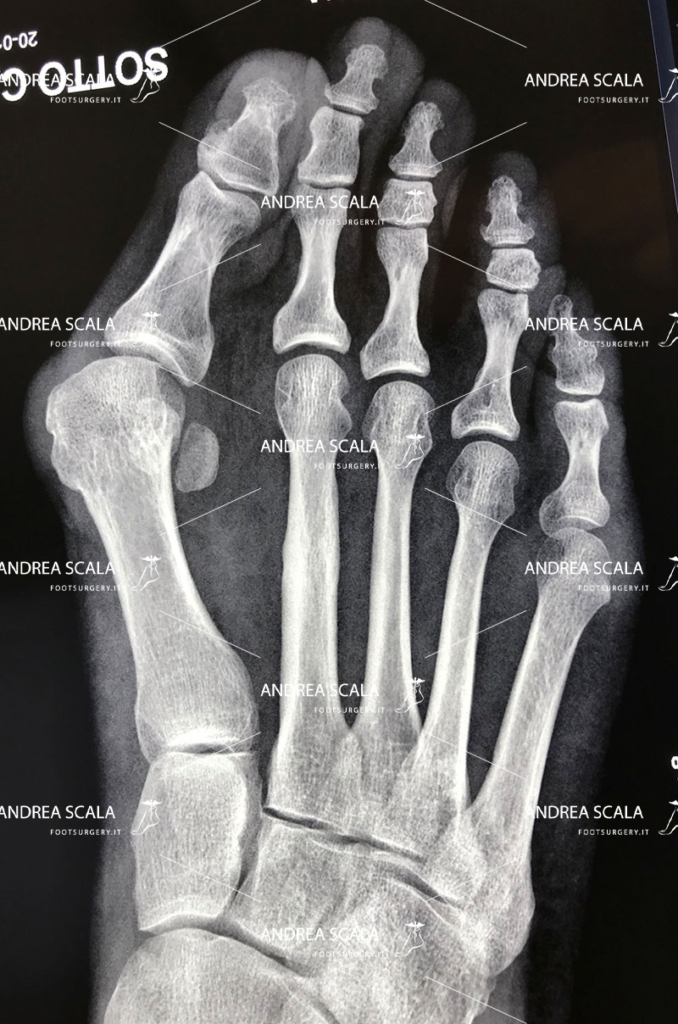 L’operazione dell’alluce eseguita con tecnica mininvasiva