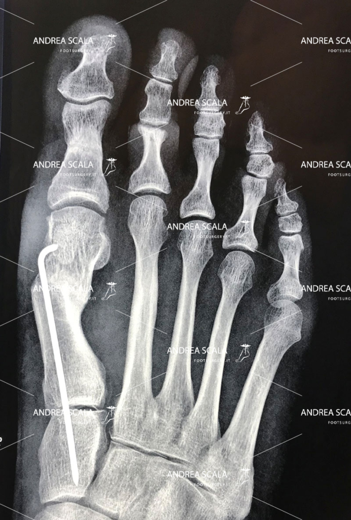 L’operazione dell’alluce eseguita con tecnica mininvasiva
