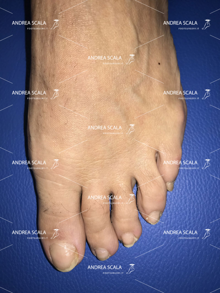 L’operazione dell’alluce eseguita con tecnica mininvasiva
