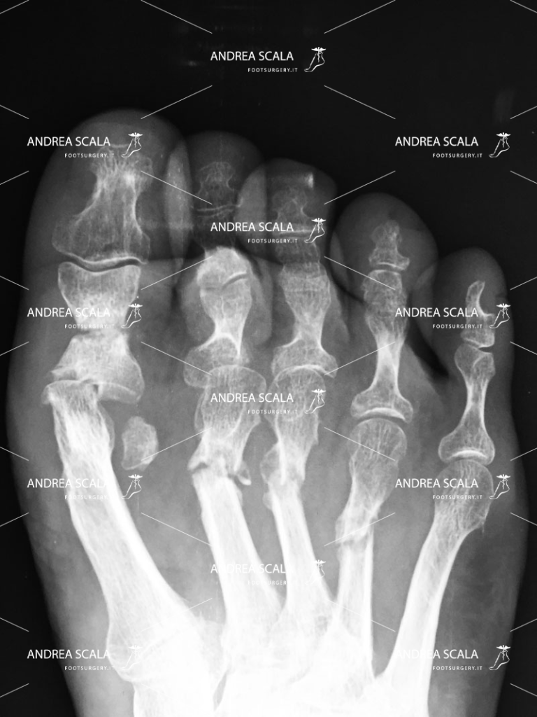 L’operazione dell’alluce eseguita con tecnica percutanea