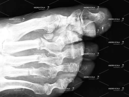 L’operazione dell’alluce eseguita con tecnica percutanea