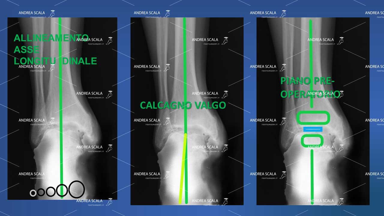 allineamento caviglia