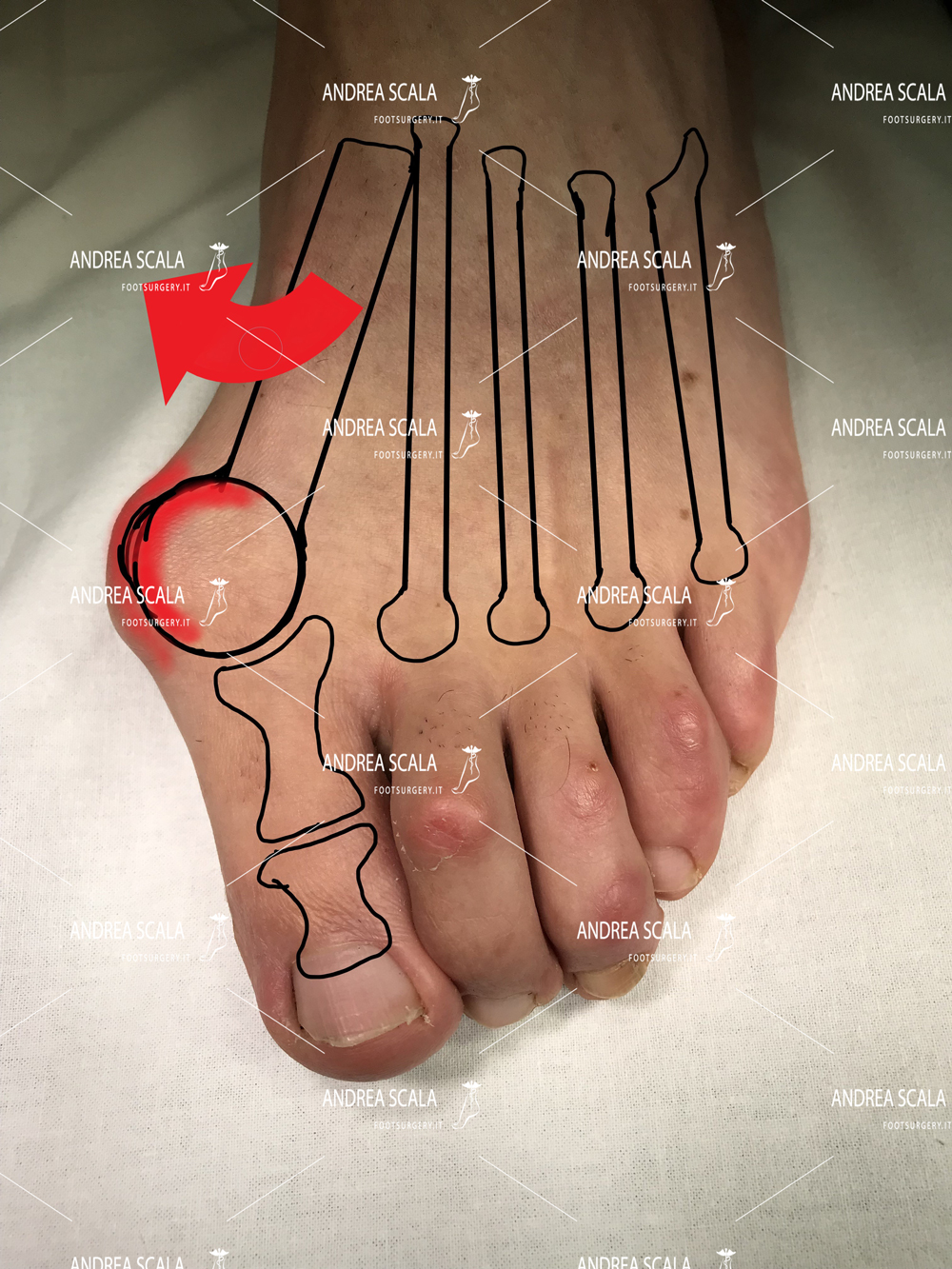 alluce-valgo-allontanamento-metatarso