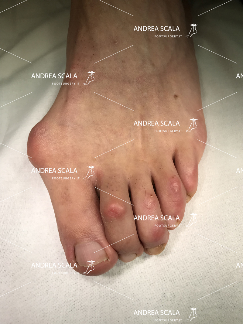 alluce-valgo-aspetto-clinico
