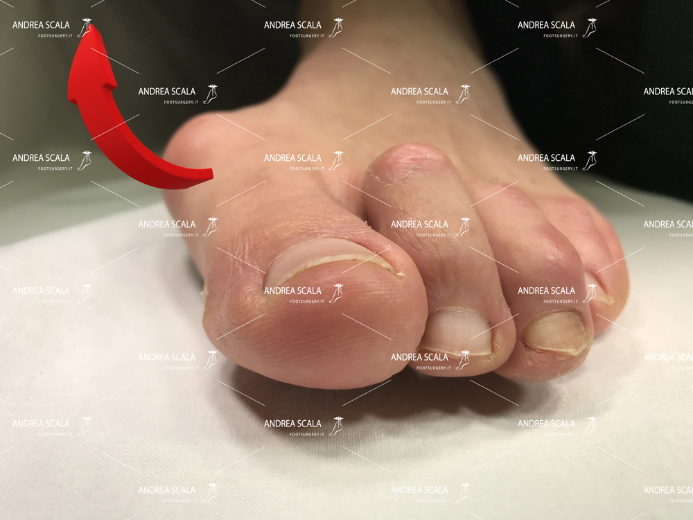 Alluce valgo metatarso spostamento alto