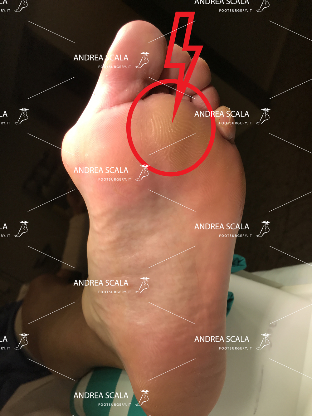 alluce-valgo-sede-callosita