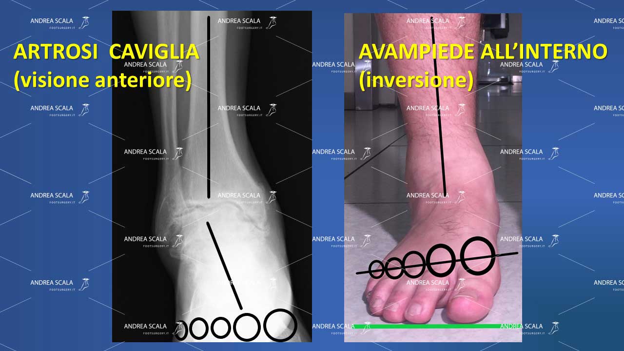 artrosi caviglia anteriore