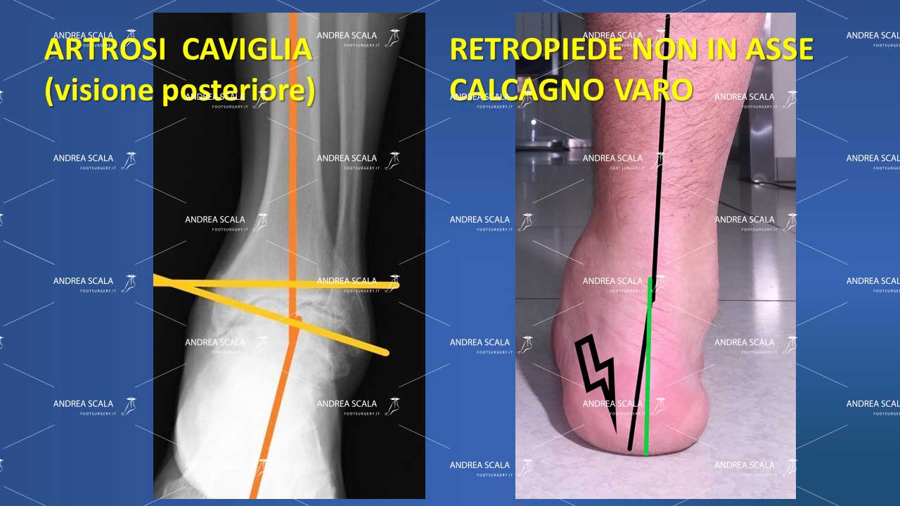 artrosi caviglia posteriore
