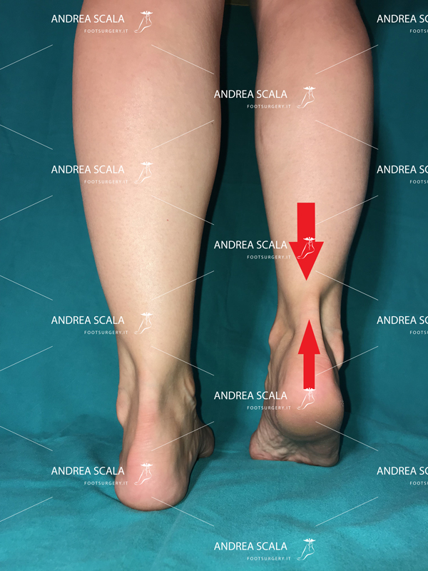 causa-del-tendine-d’Achille