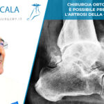 prevenzione artrosi caviglia