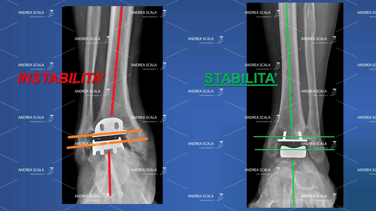 differenza protesi caviglia